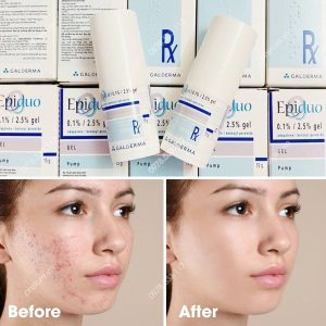 Kem trị mụn viêm, mụn mủ, mụn trứng cá Galderma Epiduo Gel 15g