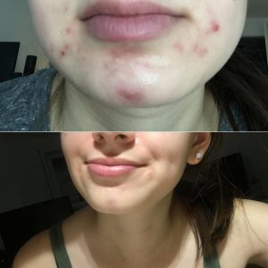 Kem trị mụn viêm, mụn mủ, mụn trứng cá Galderma Epiduo Gel 15g