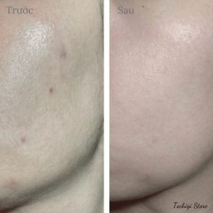 Serum Melano CC Vitamin C, E ngừa mụn và dưỡng trắng